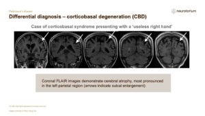 Differential diagnosis – corticobasal degeneration (CBD)